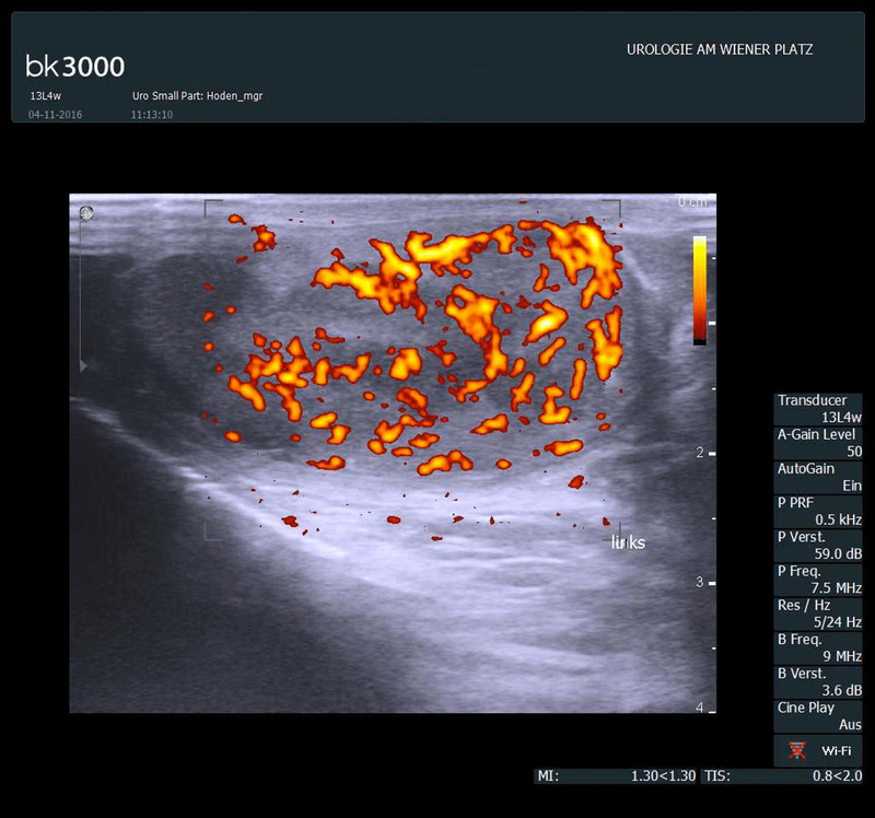 Ultraschall Duplex-Sonographie Hodentumor