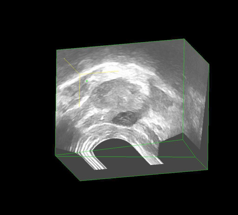 3D-Prostata Ultraschall Diagnostik eines Prostatakarzinoms