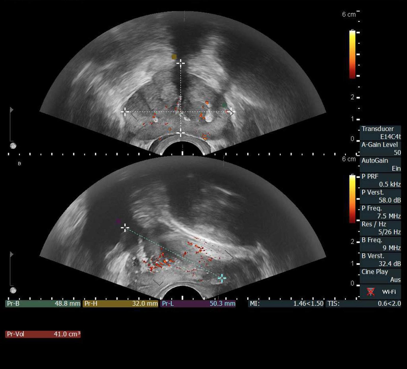 Ultraschalluntersuchung der Prostata